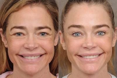 Новое лицо Дениз Ричардс после пластической операции