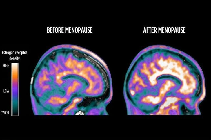В Корнеллском университете выяснили, что происходит с мозгом во время менопаузы