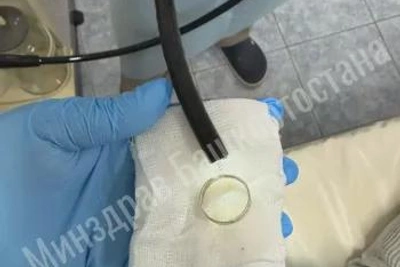 Уфимские врачи извлекли кольцо из пищевода 65-летней женщины