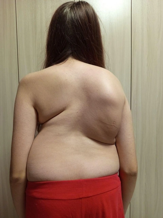 Сейчас спина Тани выглядит вот так | Источник: из архива Светланы Белоусовой