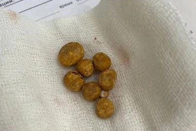 Мочевой пузырь воронежца забился камнями после лечения травами