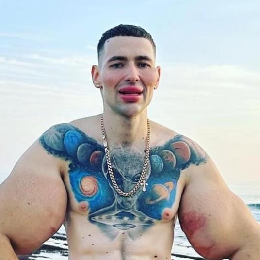 «Руки-базуки» Кирилл Терешин может остаться без конечностей: блогеру с огромными бицепсами грозит ампутация