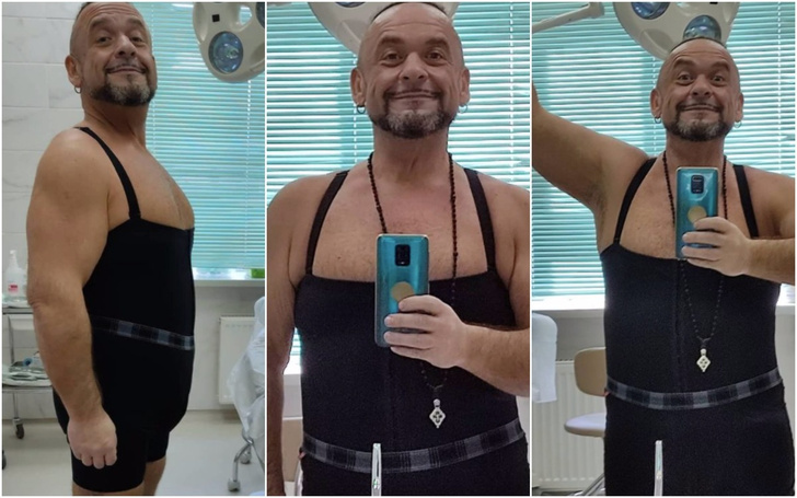 Как выглядит Александр Морозов после удаления обвисшей кожи — фото