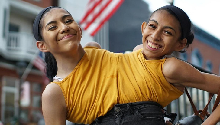 Как живут сиамские близняшки из Мексики, которых мать отказалась разделять