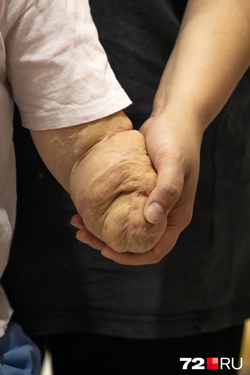 — Сказали, что передается это заболевание воздушно-капельным путем. То есть она могла за ручку схватиться где-нибудь, нос почесать. И где оно взялось, уже непонятно, — рассказывает Анастасия | Источник: Максим Майер / 72.RU