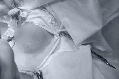 В Пятигорске подростку удалили кисту шеи размером с яблоко