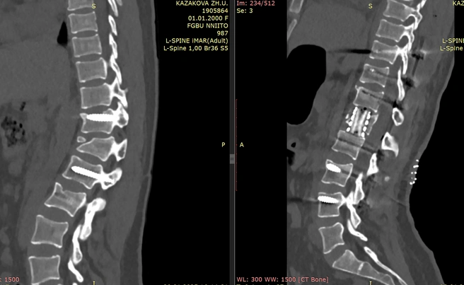Слева позвоночник Жибек до операции, справа — после работы новосибирских врачей | Источник: Новосибирский НИИТО им. Я. Л. Цивьяна