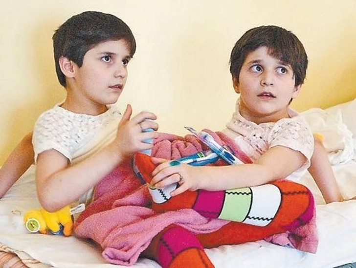 Что случилось со знаменитыми сиамскими близняшками Зитой и Гитой