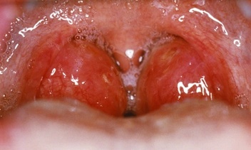 Заболело горло: тонзиллит у ребенка