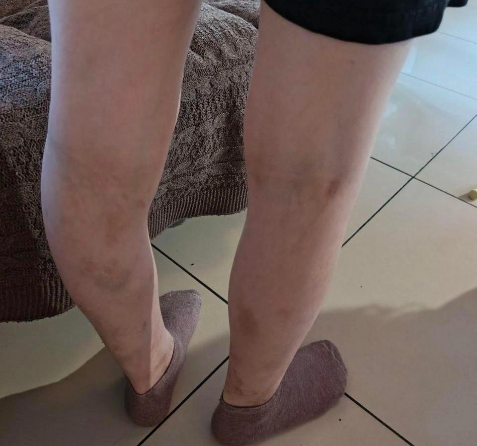 По словам одной из заявительниц, так выглядели ноги мальчика, который воспитывался в семье опекунов | Источник: читатель 72.RU