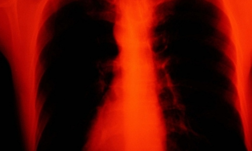 Заболеваемость туберкулезом на Северо-Западе вдвое ниже, чем в России