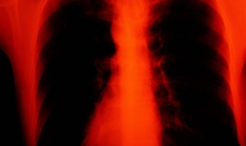 Фото №1 - Заболеваемость туберкулезом на Северо-Западе вдвое ниже, чем в России