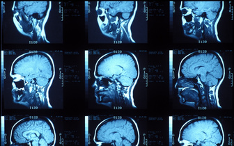 Ученые научились различать депрессию от биполярного расстройства по МРТ