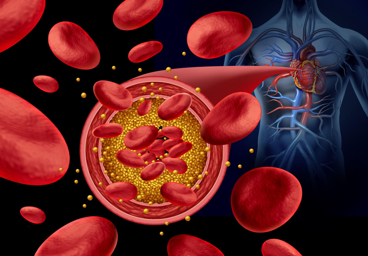 5 признаков того, что у вас повышенный холестерин
