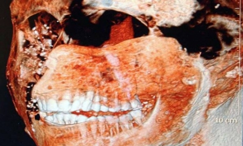 Зубы древних римлян были здоровее, чем у современных людей