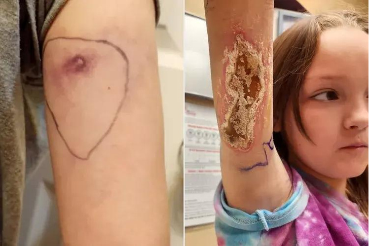 9-летняя девочка чуть не умерла от укуса паука-отшельника