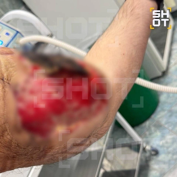 «Руки-Базуки» почернели и гниют: Кирилл Терешин может лишиться конечностей