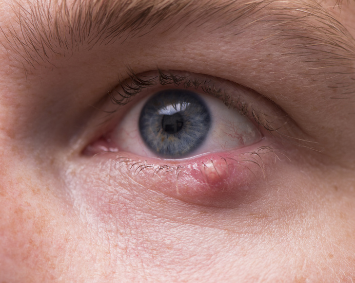 Не болезнь, а проклятие: как быстро вылечить ячмень на глазу