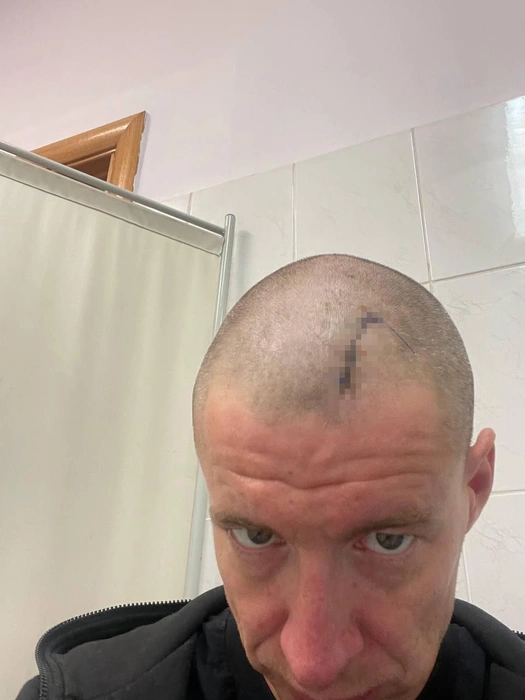 В больнице рану зашили. Однако шрам на фото всё равно выглядит шокирующе | Источник: Василий Савочкин