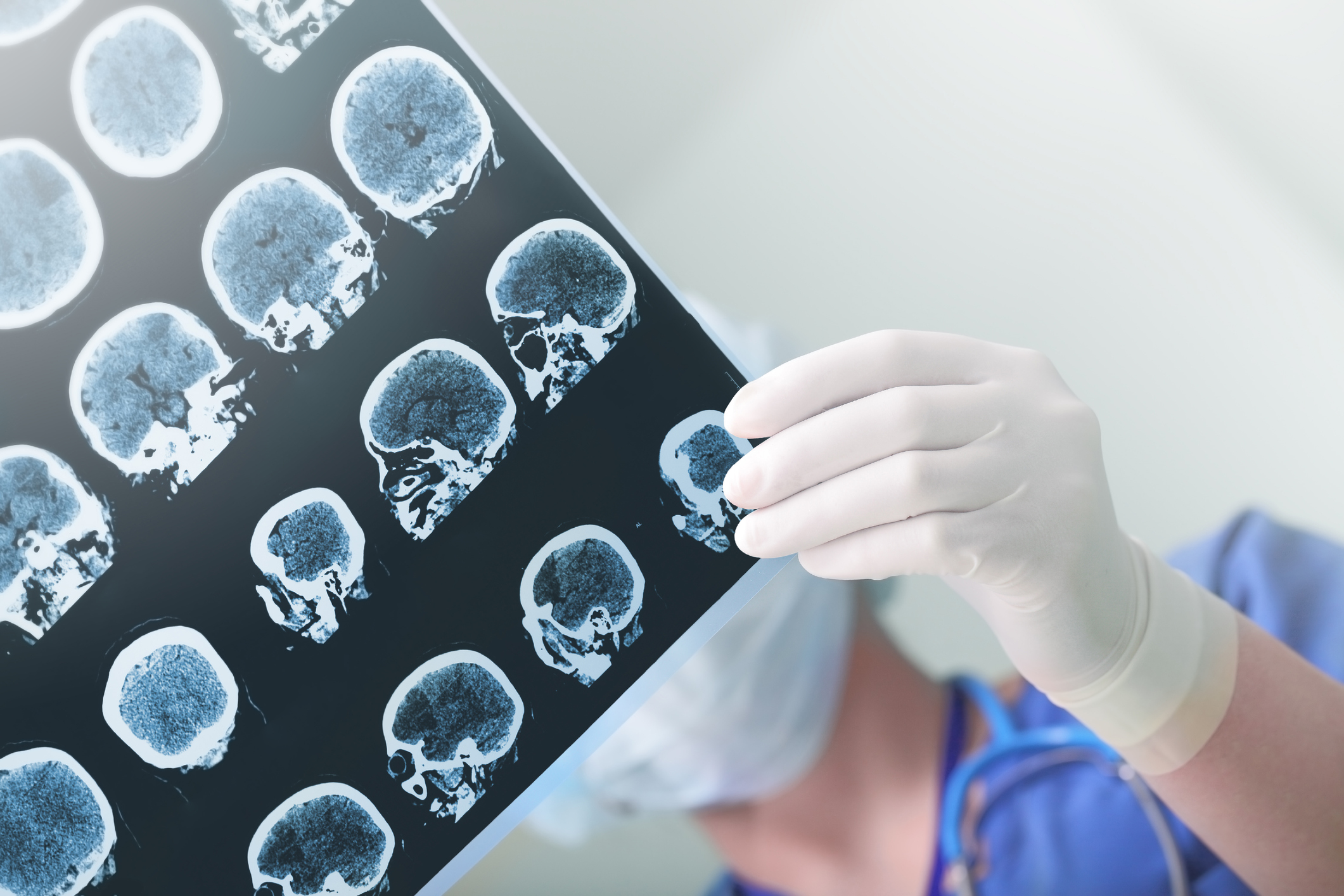 Университет Линчепинга: «У людей с постковидным синдромом изменилось строение мозга» | DOCTORPITER