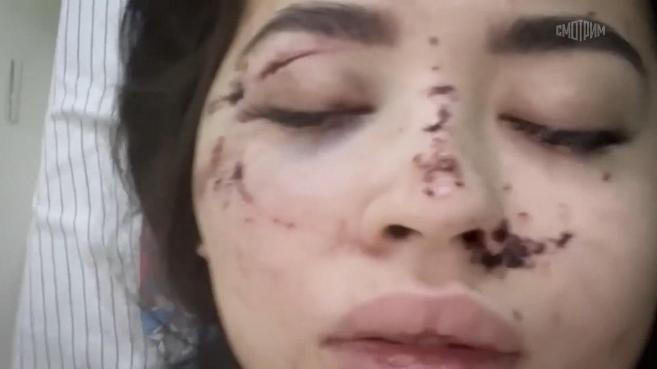 Бойфренд избил миллионершу Марию Молонову, которая искала любовь на шоу «МАЛАХОВ»