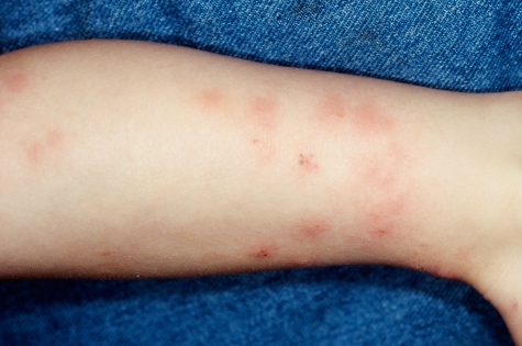 Аллергический дерматит у ребенка: симптомы
