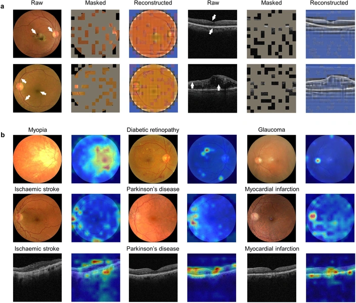 Зрит в корень: искусственный интеллект научили выявлять риск инфаркта, инсульта и болезни Паркинсона по сетчатке