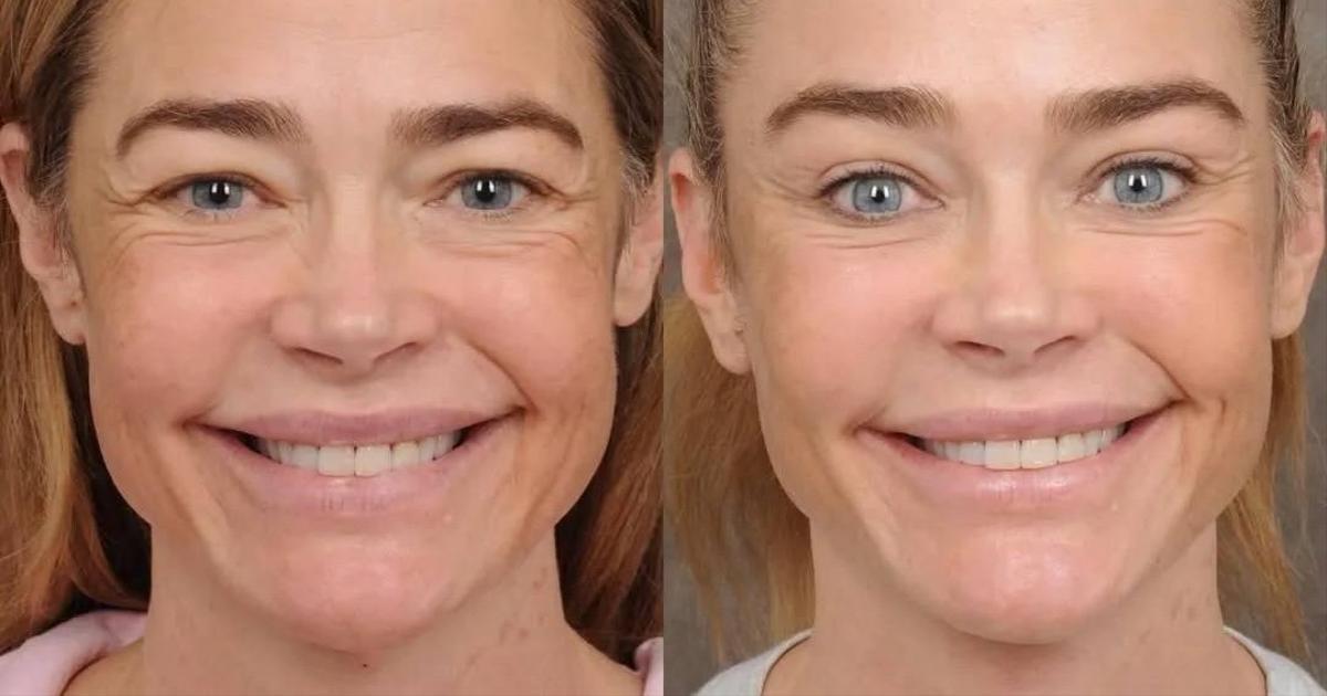 Дениз Ричардс вернула себе лицо 20-летней: до и после феноменальной пластики актрисы