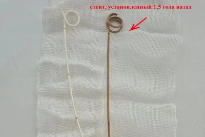 В Воронеже стент врос в мочеточник из-за задержки осмотра