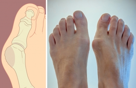 Косточка на ноге: как убрать косточку на большом пальце ноги