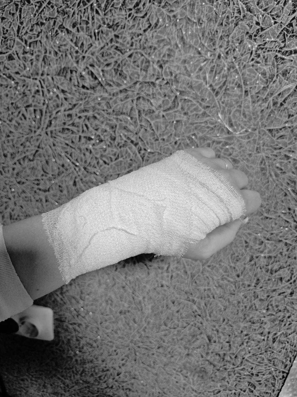 «Последствия после сноуборда. Перелома, слава богу, нет, на выходных опять поеду кататься»,&nbsp;— написала Анастасия | Источник: читательница E1.RU
