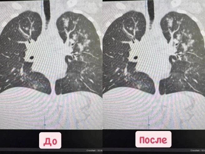 Из-за вейпов у рязанки появилась двусторонняя пневмония | Источник: Министерство здравоохранения Рязанской области