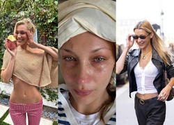 Как в США спекулируют на «хронической» болезни Лайма и что на самом деле происходит с Беллой Хадид?