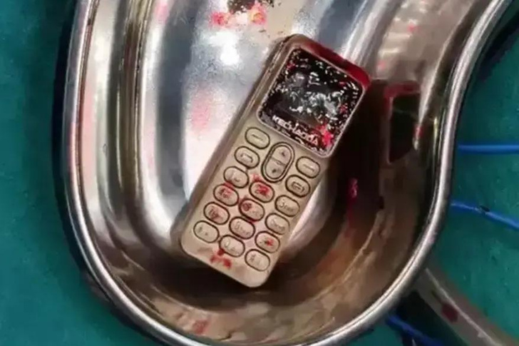 Девушка из Индии проглотила телефон во время драки с братом — фото изъятой техники
