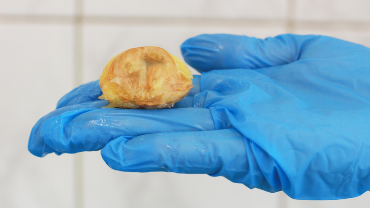 В Подмосковье врачи спасли мужчину, накануне съевшего персик