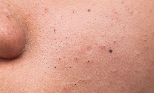 Пигментные пятна на коже: причины, симптомы, тактика лечения, риски