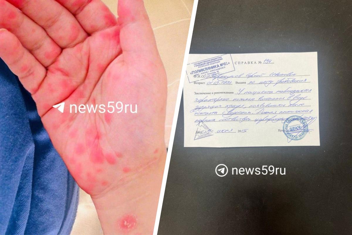 Прикамец говорил, что заразился паразитами в местном пруду: минздрав объясняет — это фейк 
