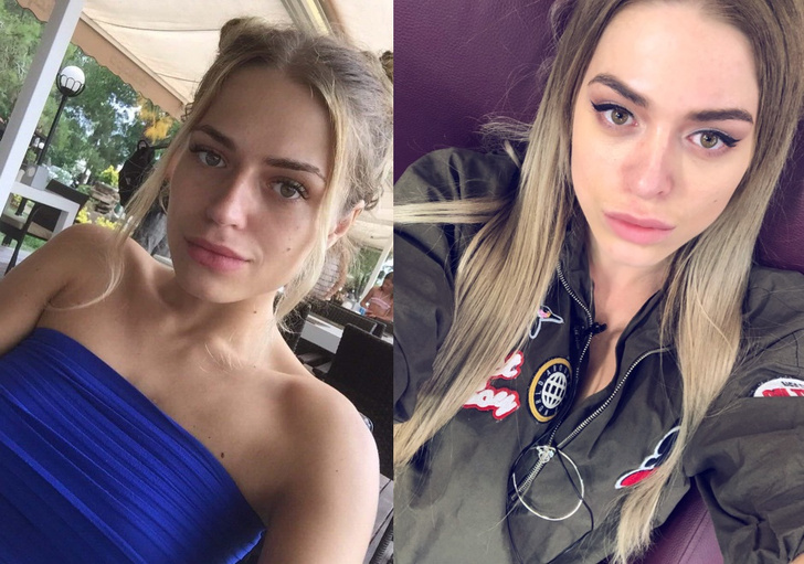 Анастасия Балинская до и после операции на нос