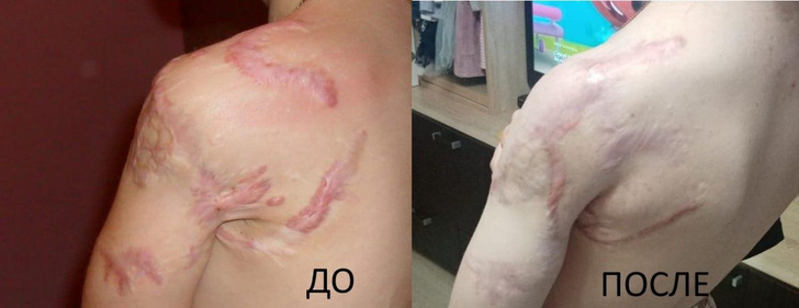 Хирурги РДКБ сохранили руку девочке, которую чуть не разорвал лев