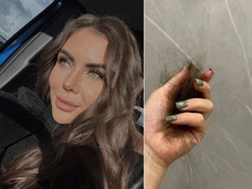 София Стужук стремительно лысеет после пластики лица — фото