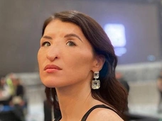 «У меня не было отставания в развитии»: девушка с носом Аватара Евгения Обирина рассказала о своем диагнозе
