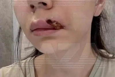 Казанка в больнице после пластики губ