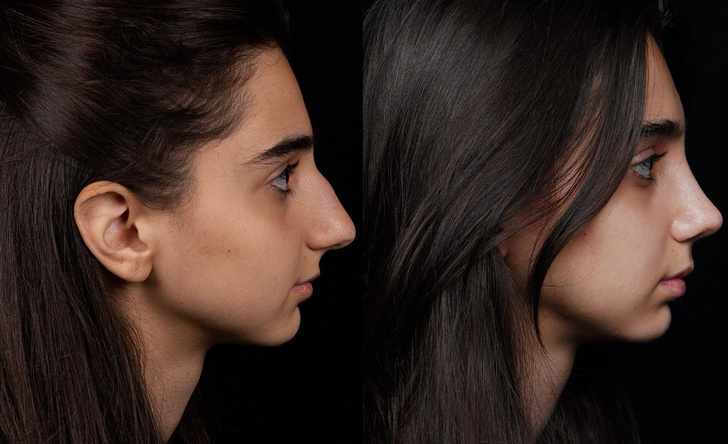 Невероятные преображение женщин до и после пластики носа: 10 фото