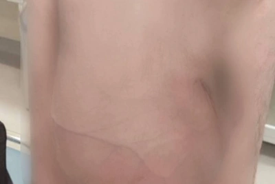 Петербуржцу удалили гигантскую грыжу, мешавшую ходить