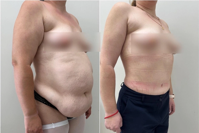 После трех родов живот совсем потерял былую форму, никакие упражнения на пресс не помогают в таких ситуациях | Источник: Евгений Олейник