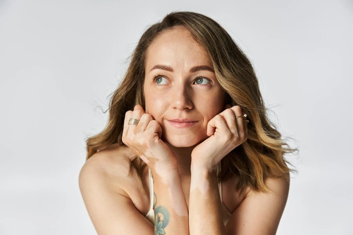 витилиго | Источник: iStockphoto/LightFieldStudios