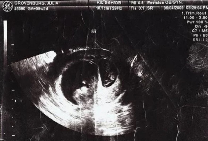 Девушка забеременела будучи беременной