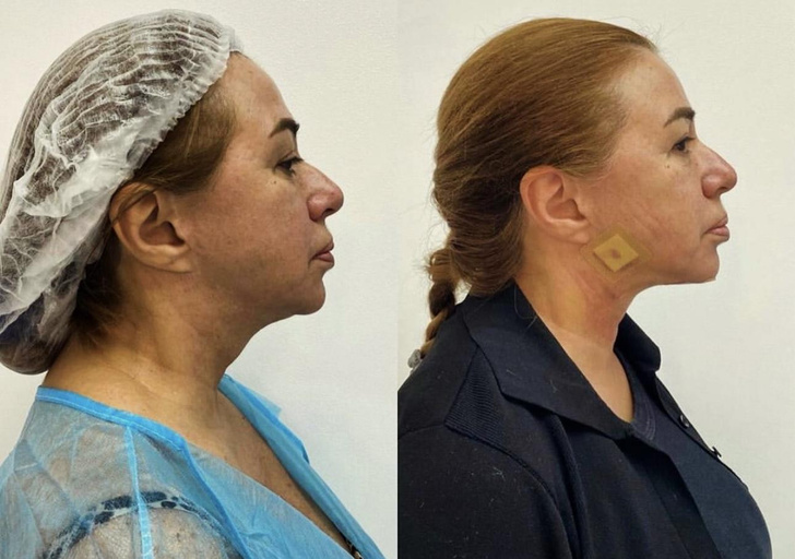 59-летняя Алена Апина сделала подтяжку подбородка — фото до и после