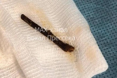 «Ветром задуло». Проктолог вытащил из нижегородца обломок ветки