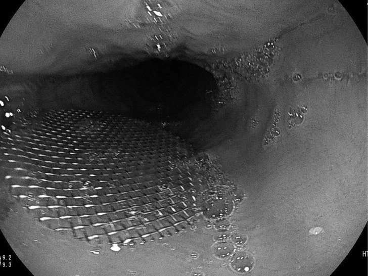 Проглотил и не заметил: у мужчины из пищевода достали металлическую сетку